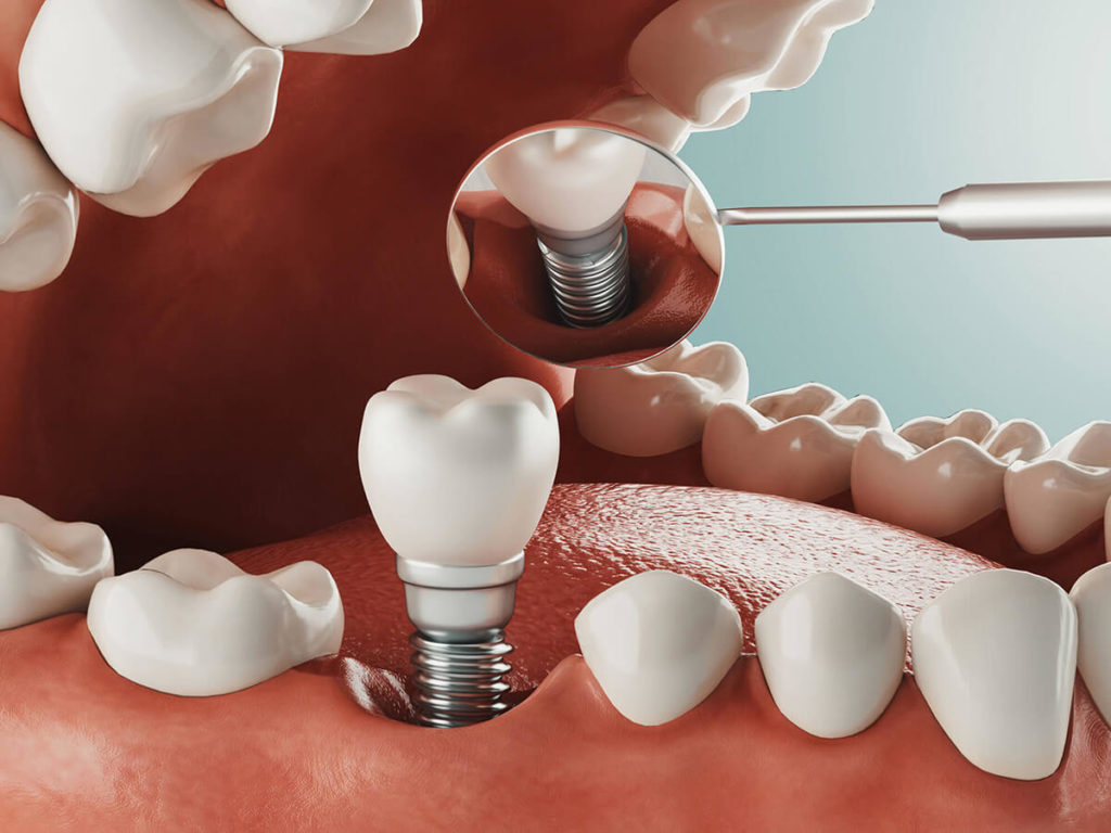 illustration of a dental implant being installed in the bottom row of teeth