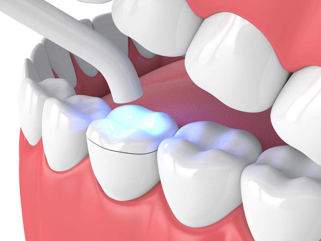 illustration of a dental inlay being applied to a tooth