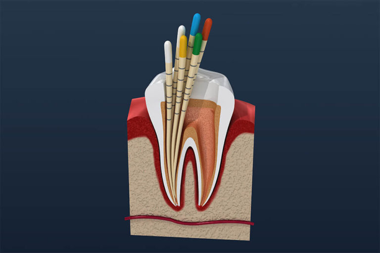 illustration of a tooth with roots obstructed, indicating that a root canal is needed