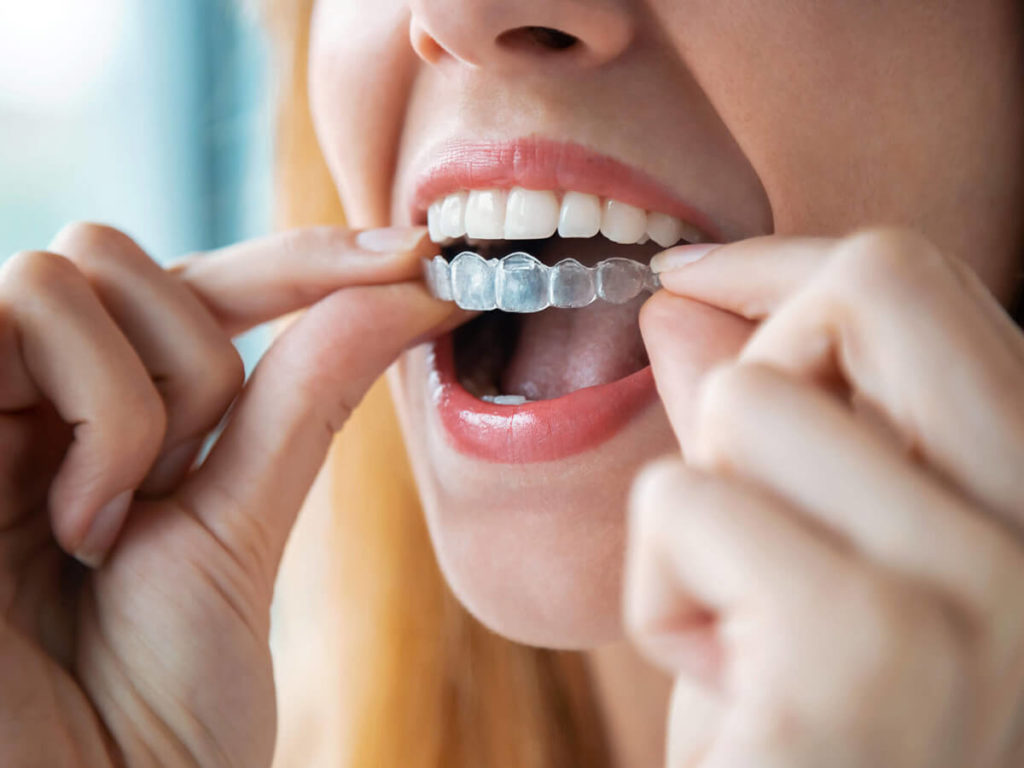 woman placing invisalign clear aligners on the top row of her teeth