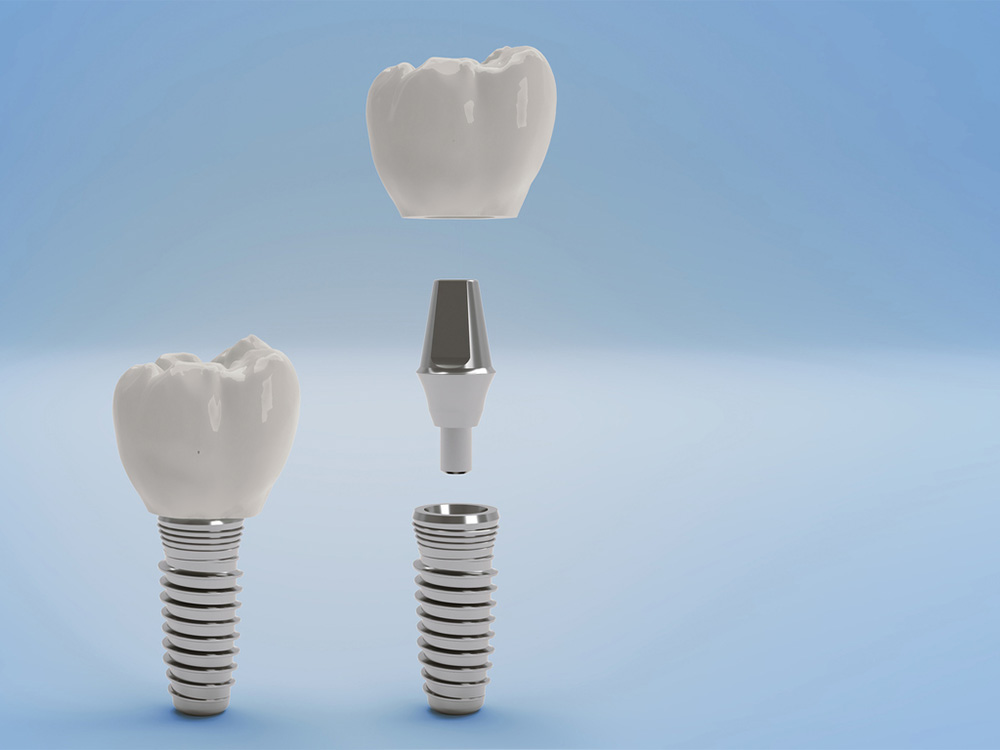 Illustration of the pieces of a dental implant, crown and abutment