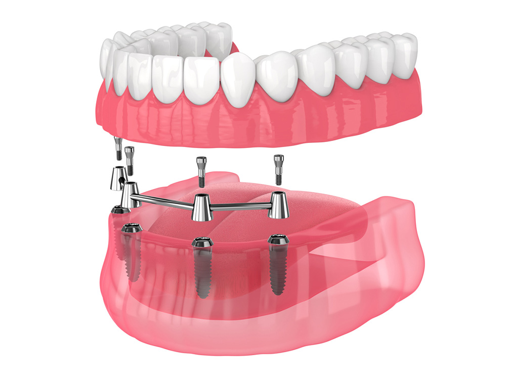3D illustration of all-on-4 dental implants